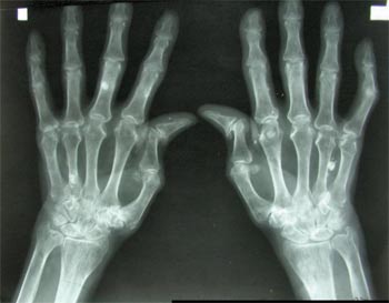 Reumatoidalne zapalenie stawów - obraz RTG dłoni