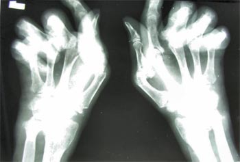 Reumatoidalne zapalenie stawów - obraz RTG dłoni - zmiany zaawansowane 
